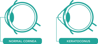 normal-vs-keratoconus